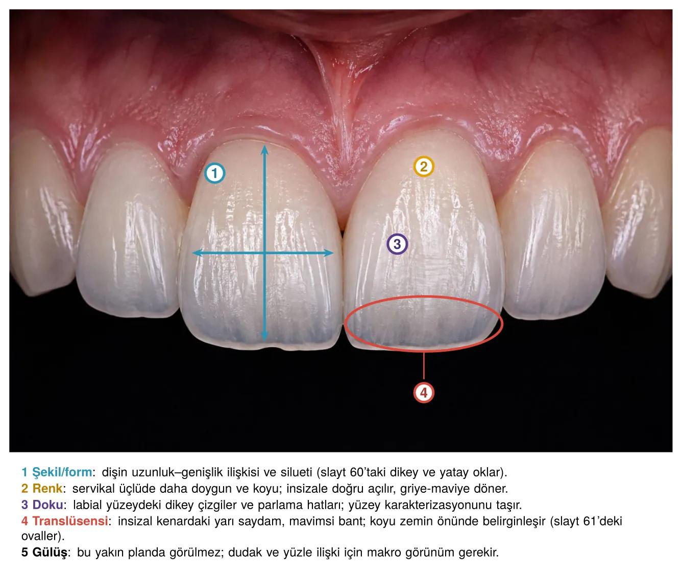 Aynı ön diş fotoğrafında şekil, renk, doku ve translüsensi