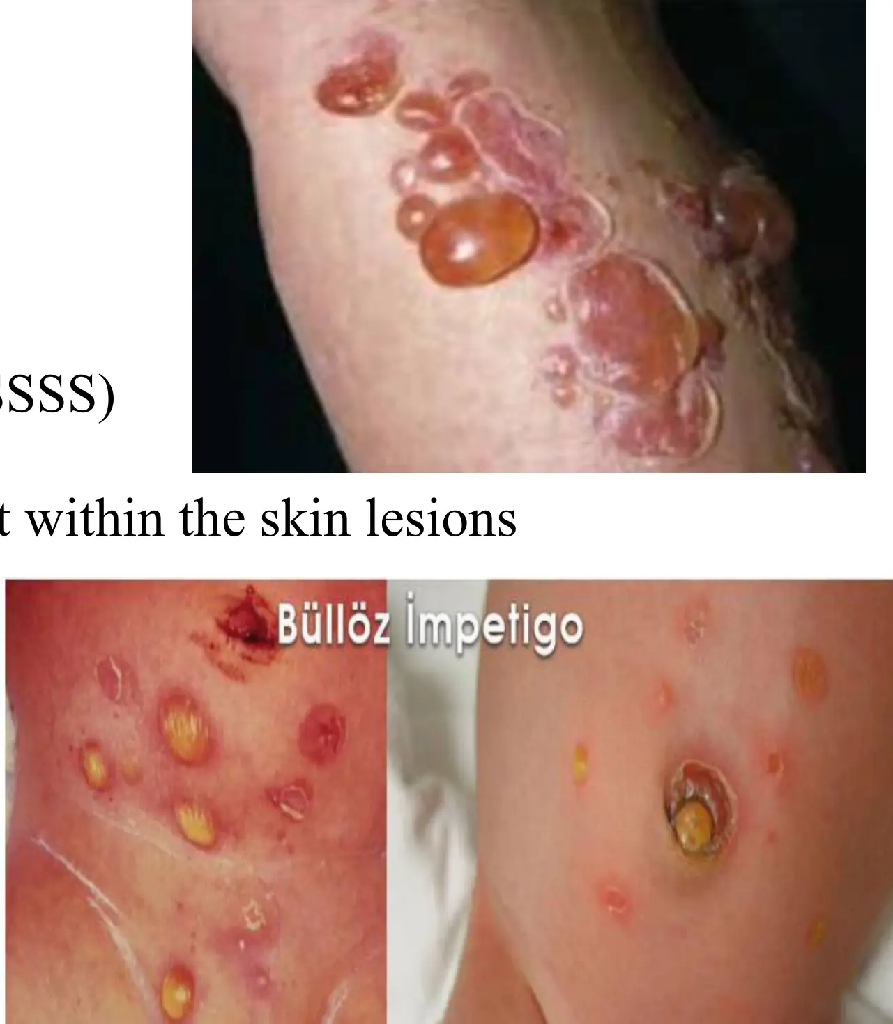 Büllöz impetigoda gevşek büller ve sınırlı deri lezyonları