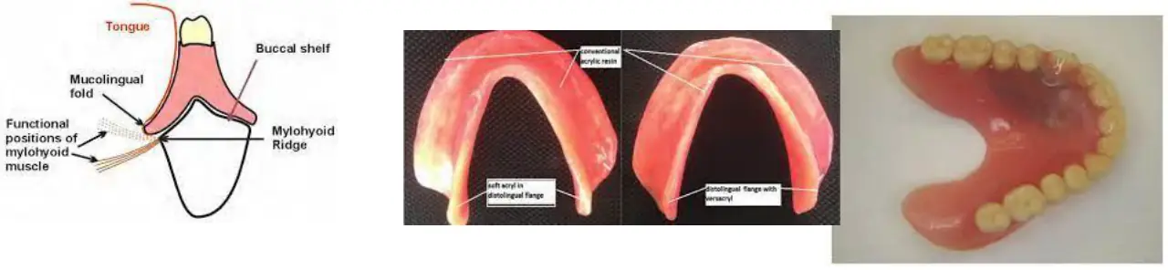 Mandibular distolingual bölge ve kenar uzatma örnekleri