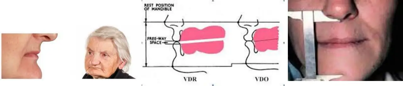 Düşük dikey boyutun yüz görünümü ve VDR–VDO–free-way space şeması