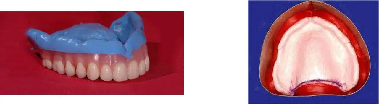 Eski protezin ölçü materyaliyle yenilenmesi ve dişsiz üst çene ölçüsü