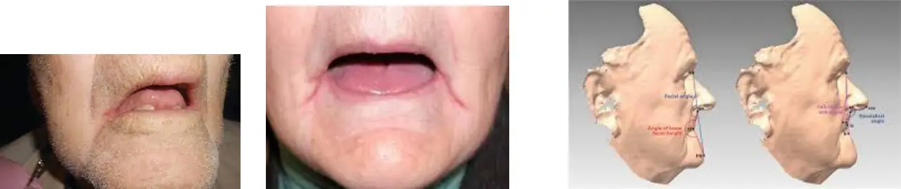 Ağız köşelerinde angular cheilitis ve yüz profili açıları