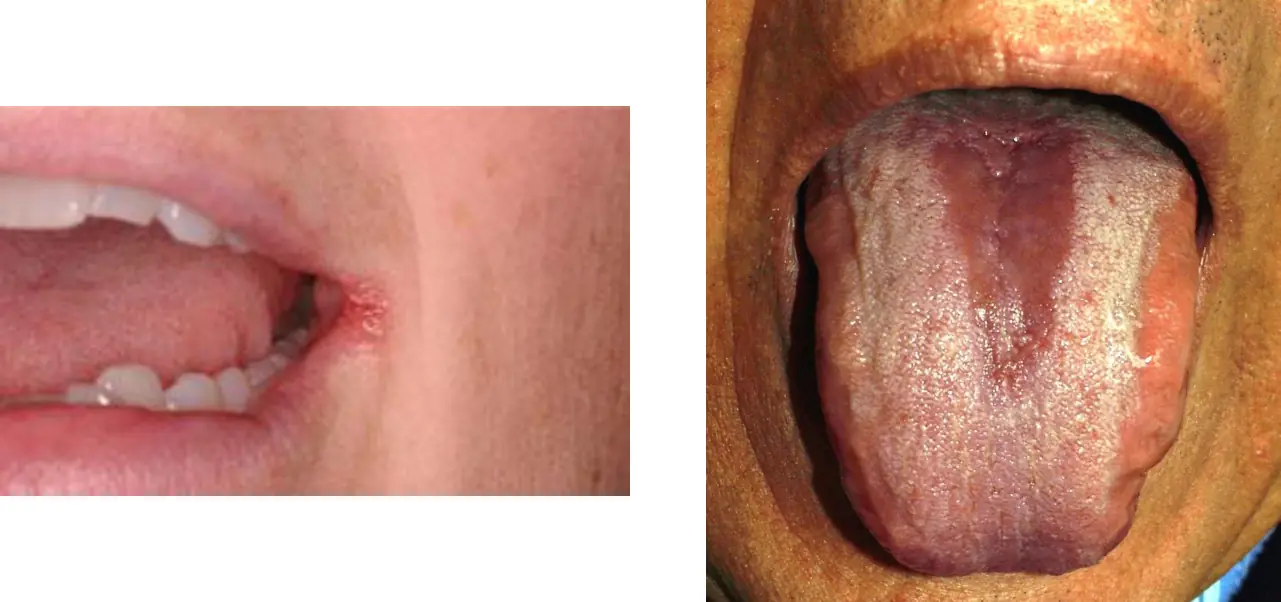 Ağız köşesinde angular cheilitis ve dil sırtında glossit: protez stomatitinde Candida'nın yayılması