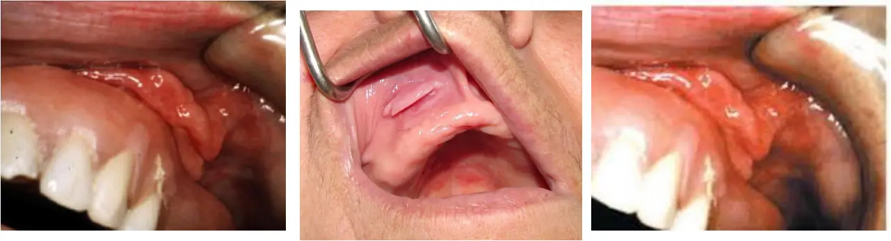 Vestibülde protez kenarı boyunca uzanan katlantılı fibröz hiperplazi (epulis fissuratum)