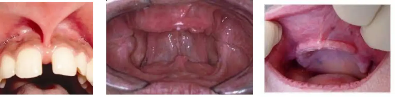 Kret tepesine uzanan yüksek labial frenulum ve dişsiz kretlerde yüzeyelleşmiş frenulum ve kas ataşmanları