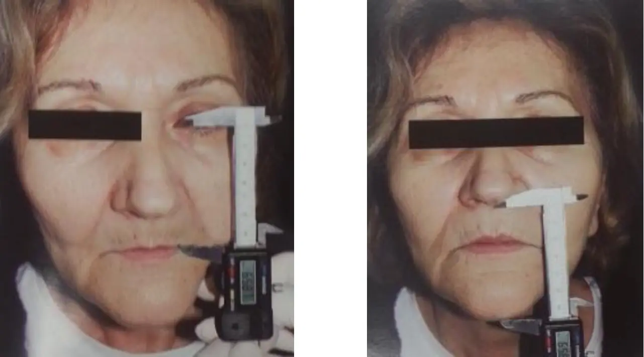 Willis tekniği: pupilla–ağız köşesi ve burun tabanı–çene mesafelerinin kumpasla ölçümü