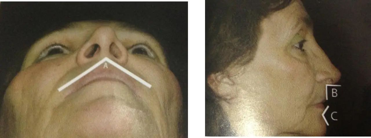 Horizontal labial (A), nazolabial (B) ve geniolabial (C) açıların gösterimi