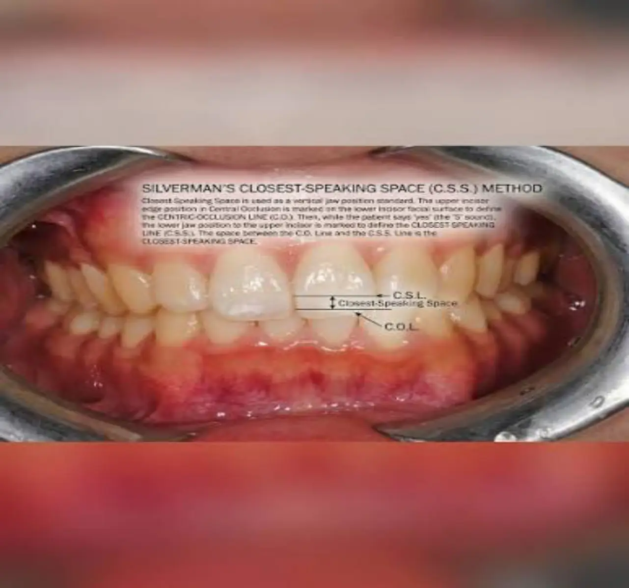 Silverman yöntemi: sentrik okluzyon hattı ile "S" sesindeki hat arasındaki en yakın konuşma mesafesi