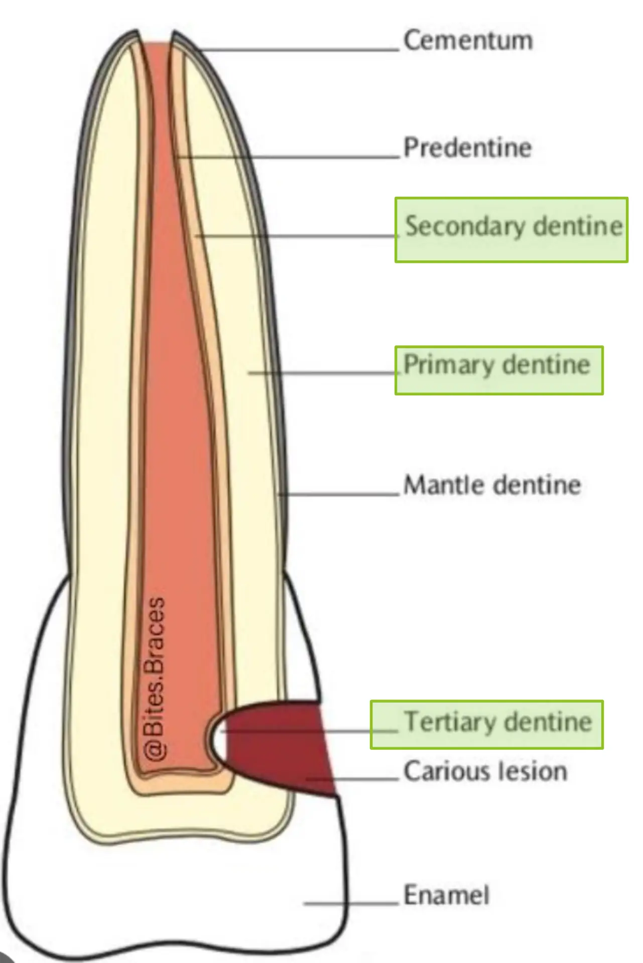 Primer, sekonder ve tersiyer dentinin dişteki yerleşimi
