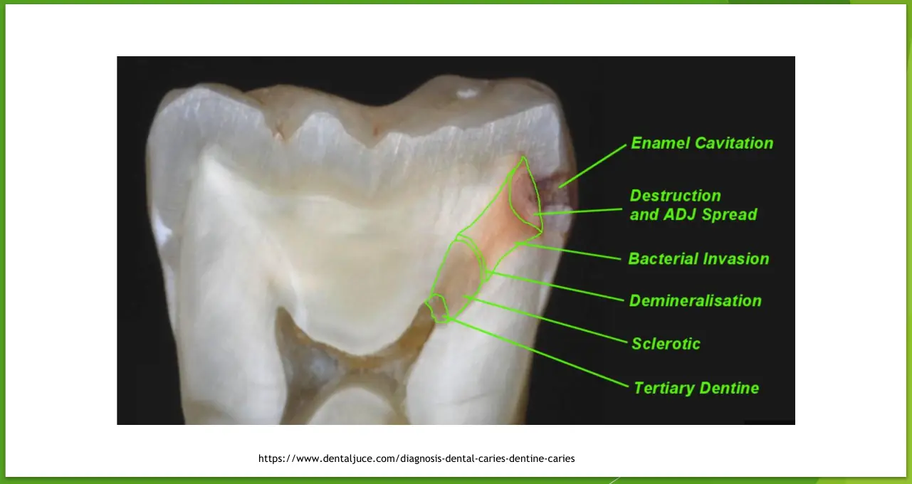 Çürük lezyonunda dentin savunma katmanları