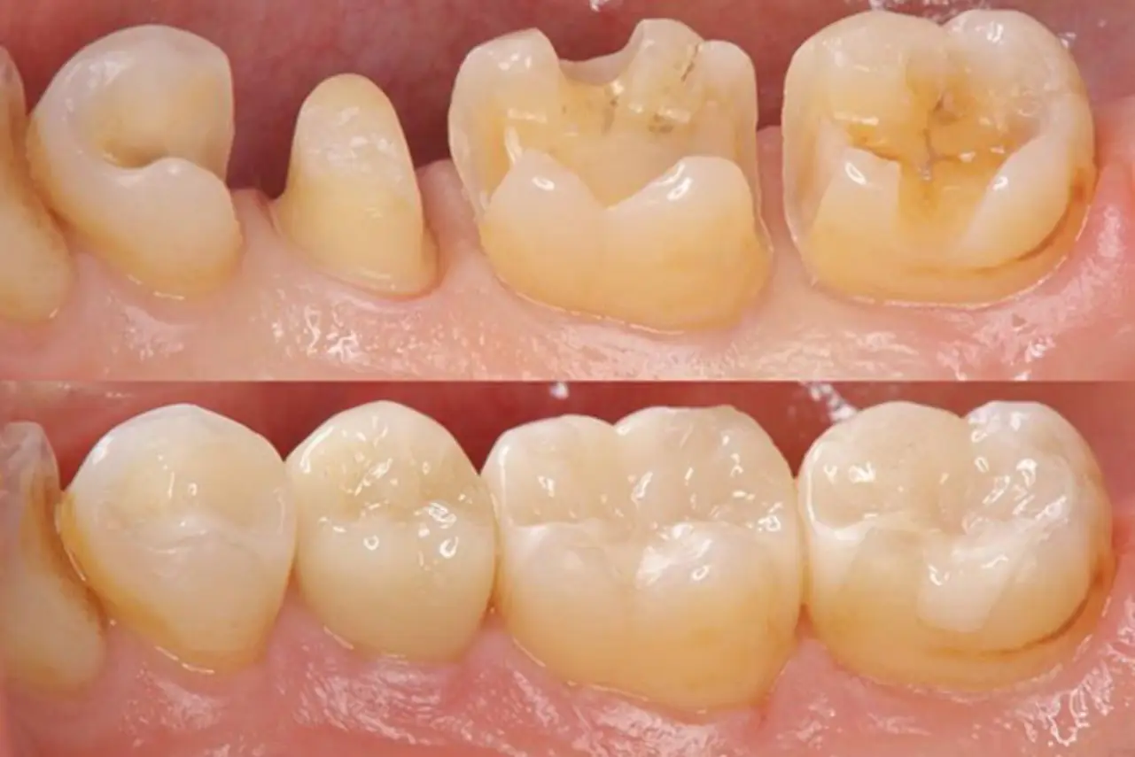 Posterior dişlerde preparasyon ve indirekt restorasyon görünümü