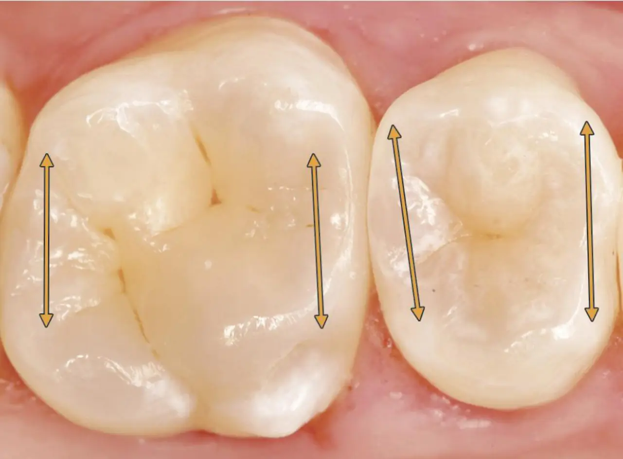 Posterior dişlerin oklüzal görünümünde marjinal kenarlar
