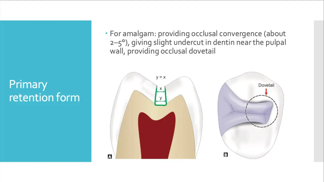 Amalgam için oklüzal yakınsama ve dovetail ile mekanik retansiyon