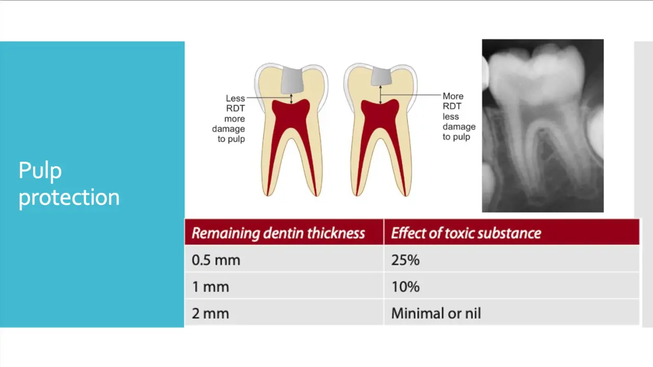 Kalan dentin kalınlığı azaldığında pulpanın etkilenme riskini gösteren şema ve tablo