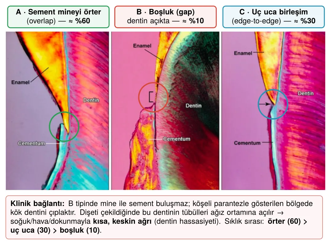 Mine–sement birleşiminin üç varyasyonu ve sıklıkları